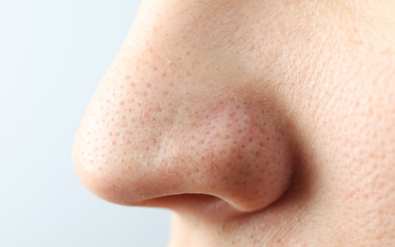 Bulbous Nose Treatment