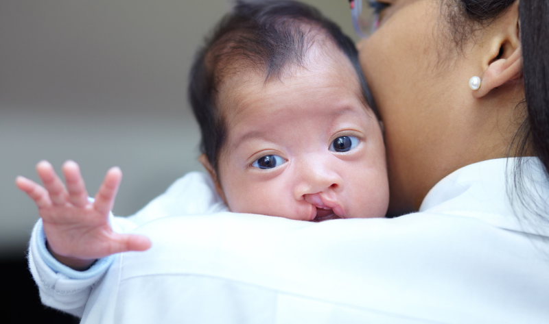 Cleft Nose Correction