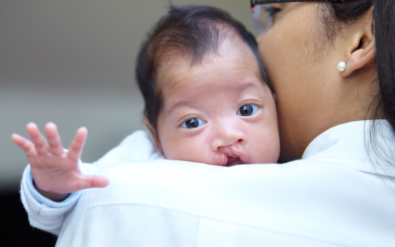 Cleft Nose Correction