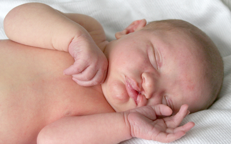 Cleft Nose Treatment