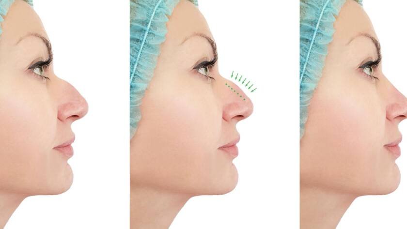 Nose-tip-reshaping