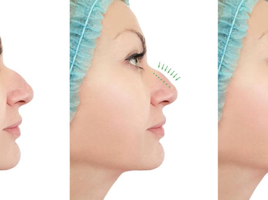 Nose-tip-reshaping
