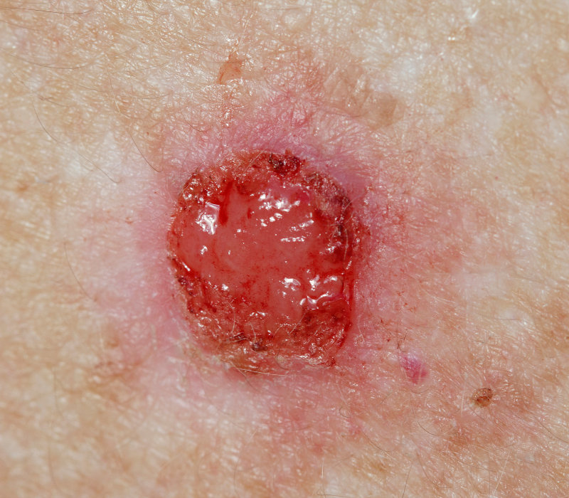 Basal Cell Carcinoma