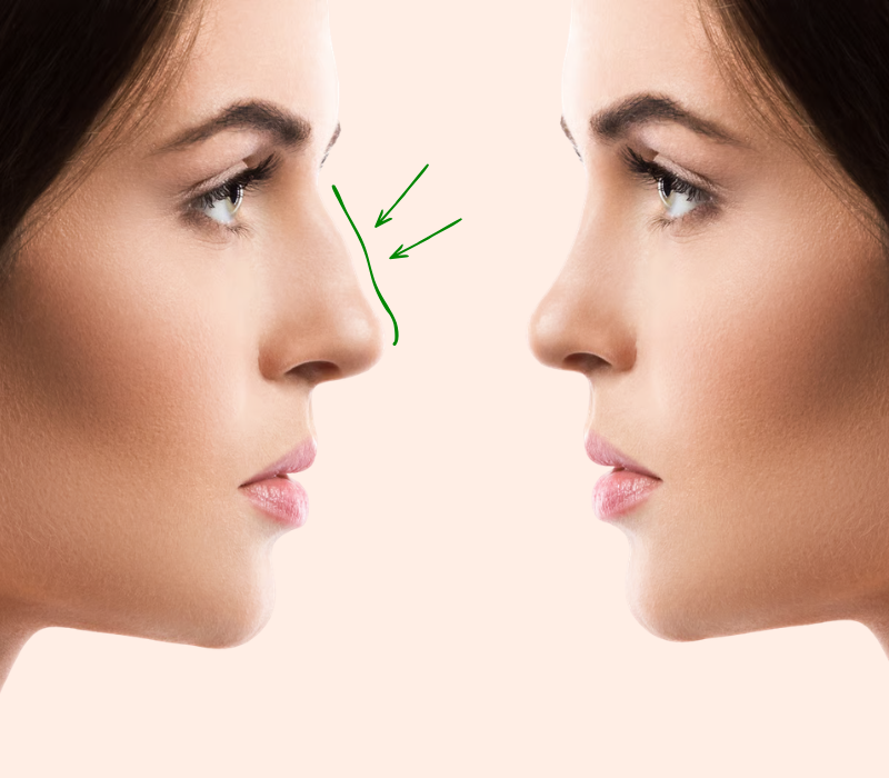 Deviated Nose Treatment