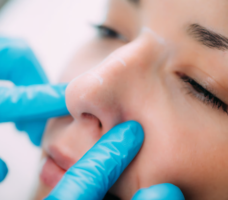 Rhinophyma Surgery