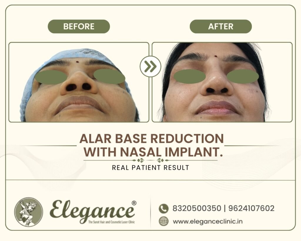 alar-base-reduction-nasal-implant-basal-view-surat