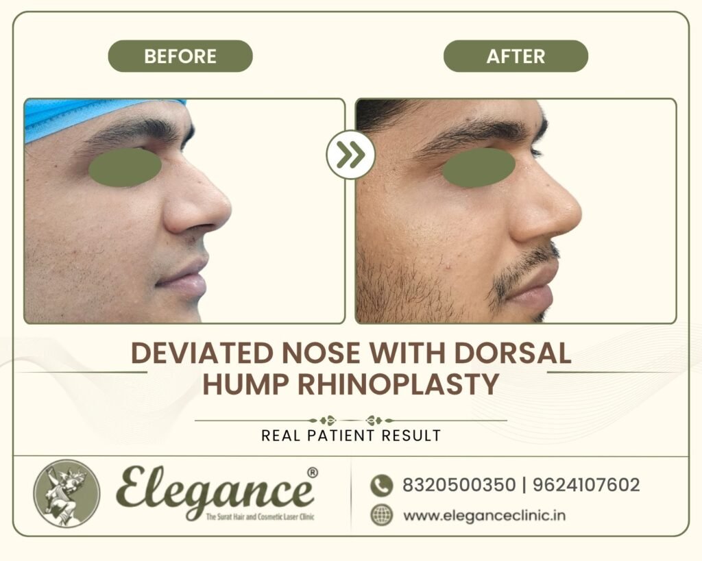 bent-nose-hump-removal-male-profile-surat