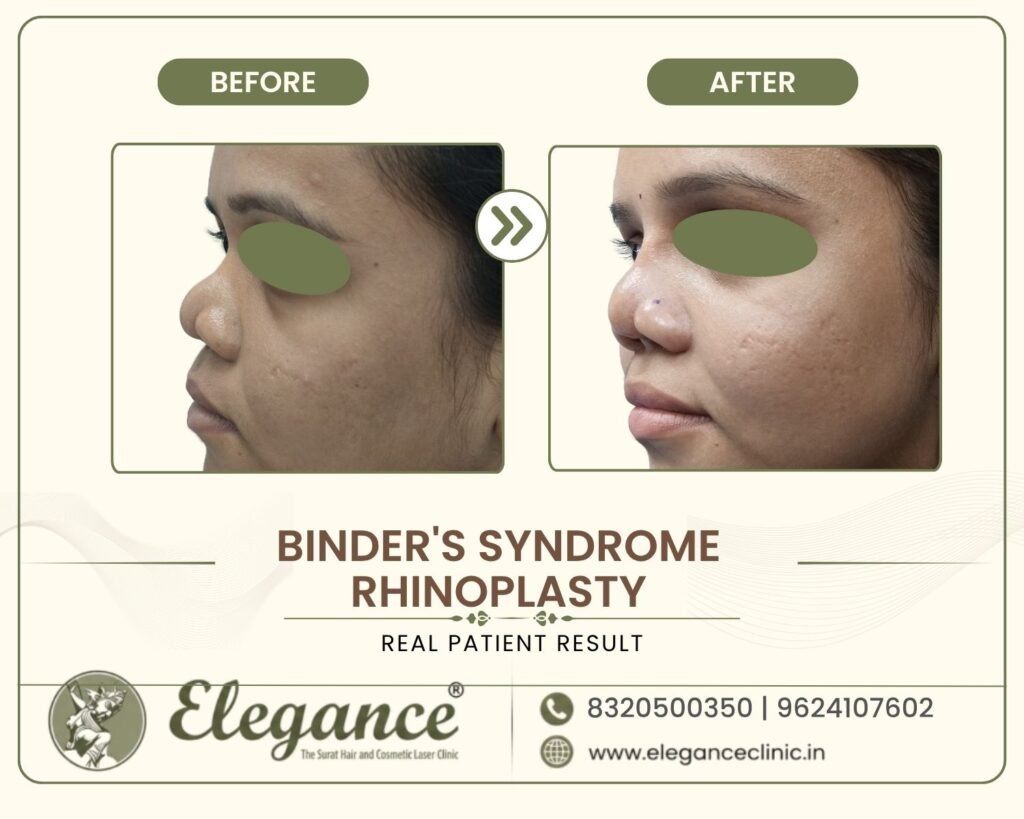 binder-syndrome-nose-reconstruction-side-profile-surat
