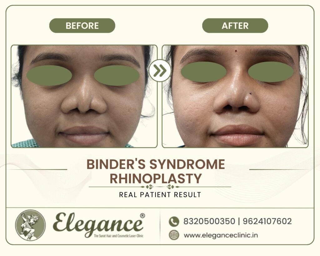 binders-syndrome-rhinoplasty-front-view-surat