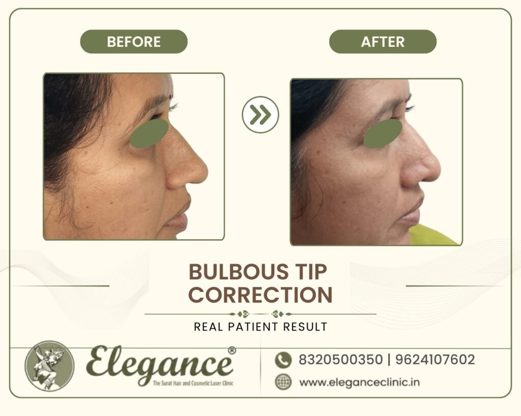 bulbous-nose-tip-plasty-female-profile-surat
