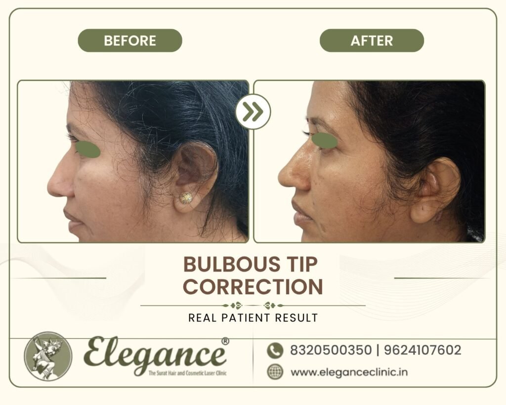 bulbous-tip-correction-rhinoplasty-side-profile-surat