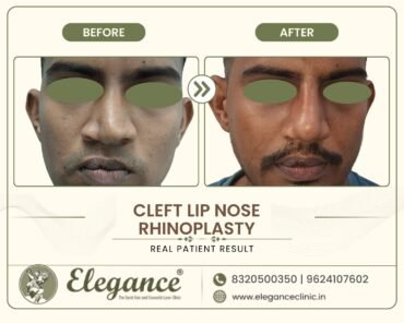 cleft-lip-nose-rhinoplasty-front-view-surat