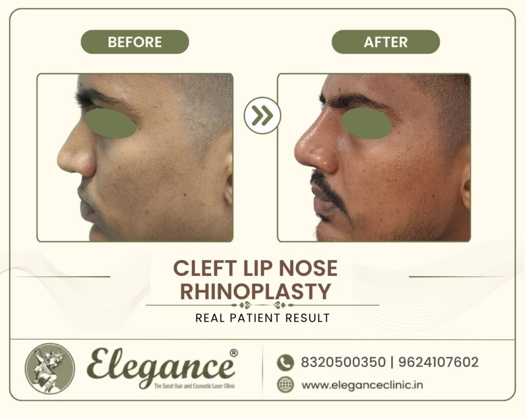 cleft-nose-deformity-correction-side-view-surat