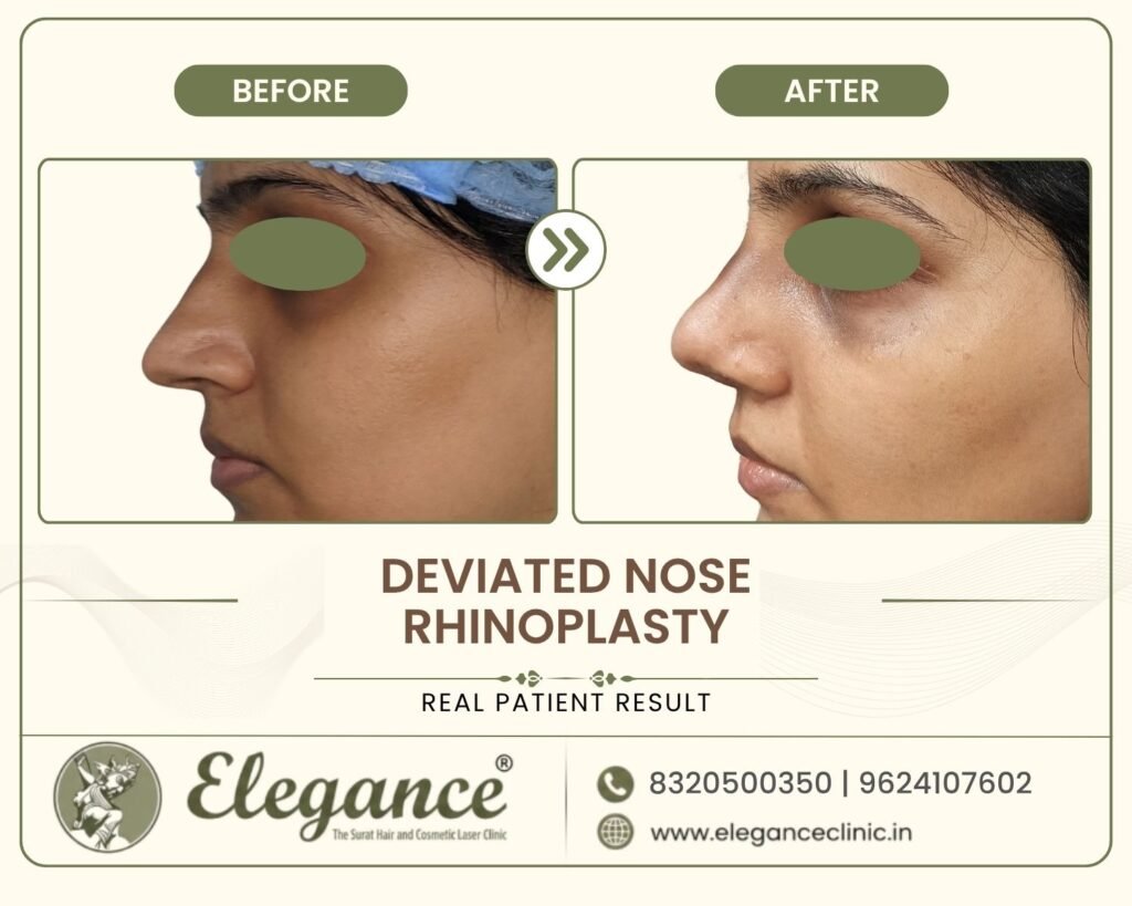 crooked-nose-correction-surgery-side-profile-surat