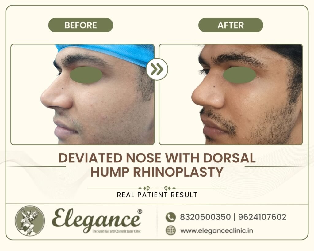 crooked-nose-with-hump-correction-side-profile-surat