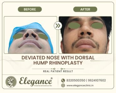 deviated-nose-dorsal-hump-rhinoplasty-basal-view-surat