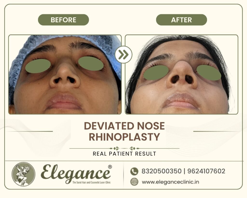 deviated-nose-rhinoplasty-basal-view-surat