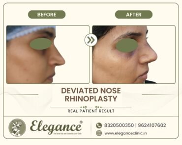 deviated-septum-nose-straightening-female-surat