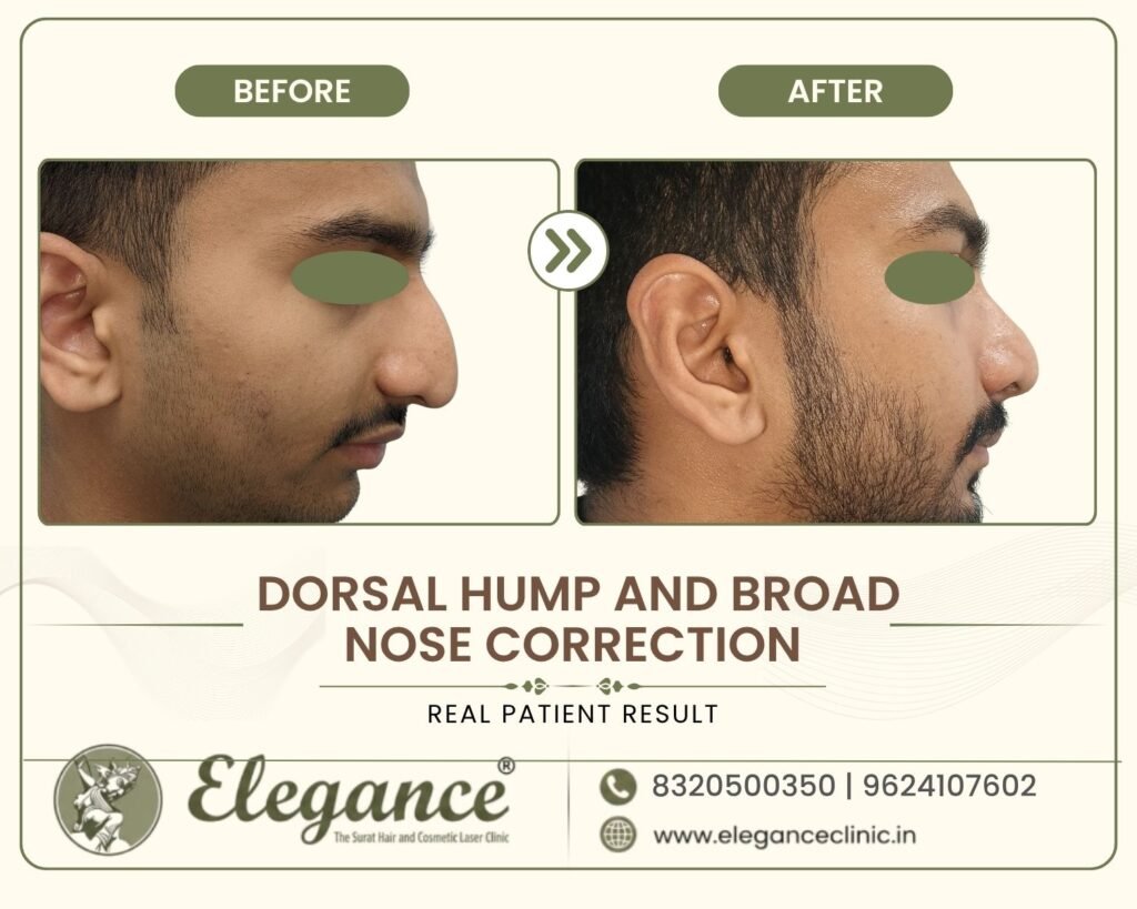 dorsal-hump-broad-nose-correction-side-profile-surat