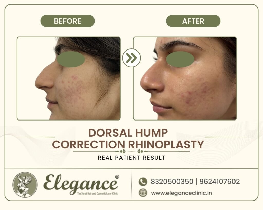 dorsal-hump-removal-rhinoplasty-side-profile-surat