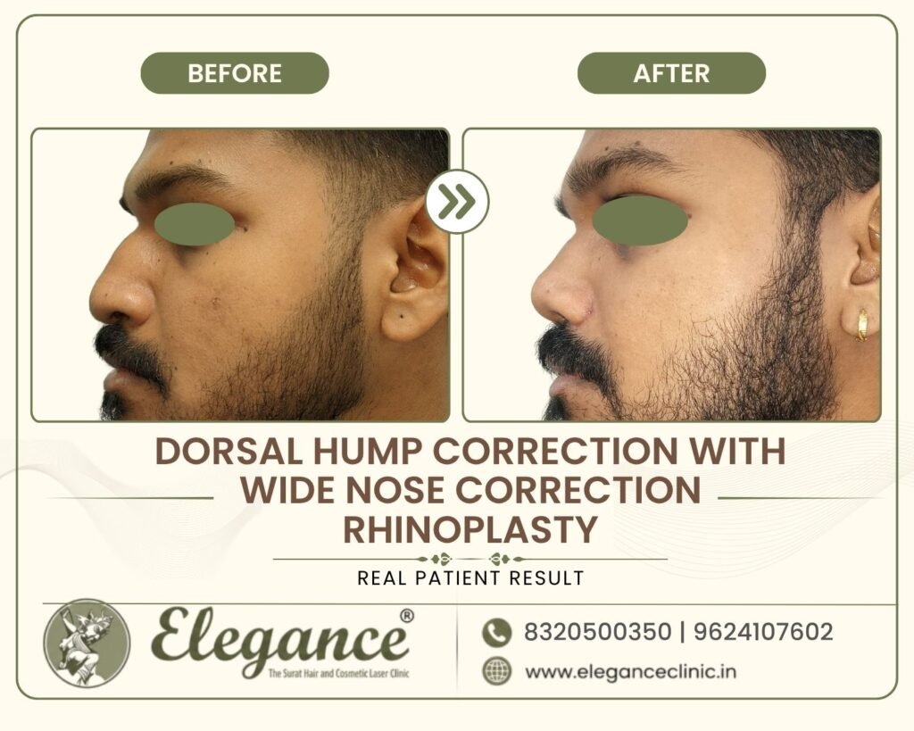 dorsal-hump-wide-nose-rhinoplasty-side-profile-surat