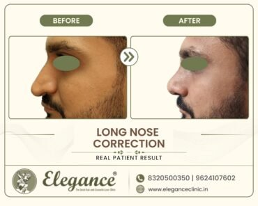 droopy-nose-tip-lift-surgery-side-profile-surat