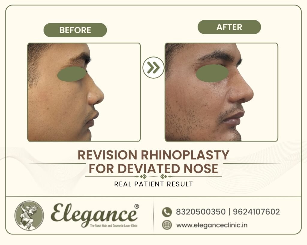 failed-rhinoplasty-correction-deviated-nose-surat