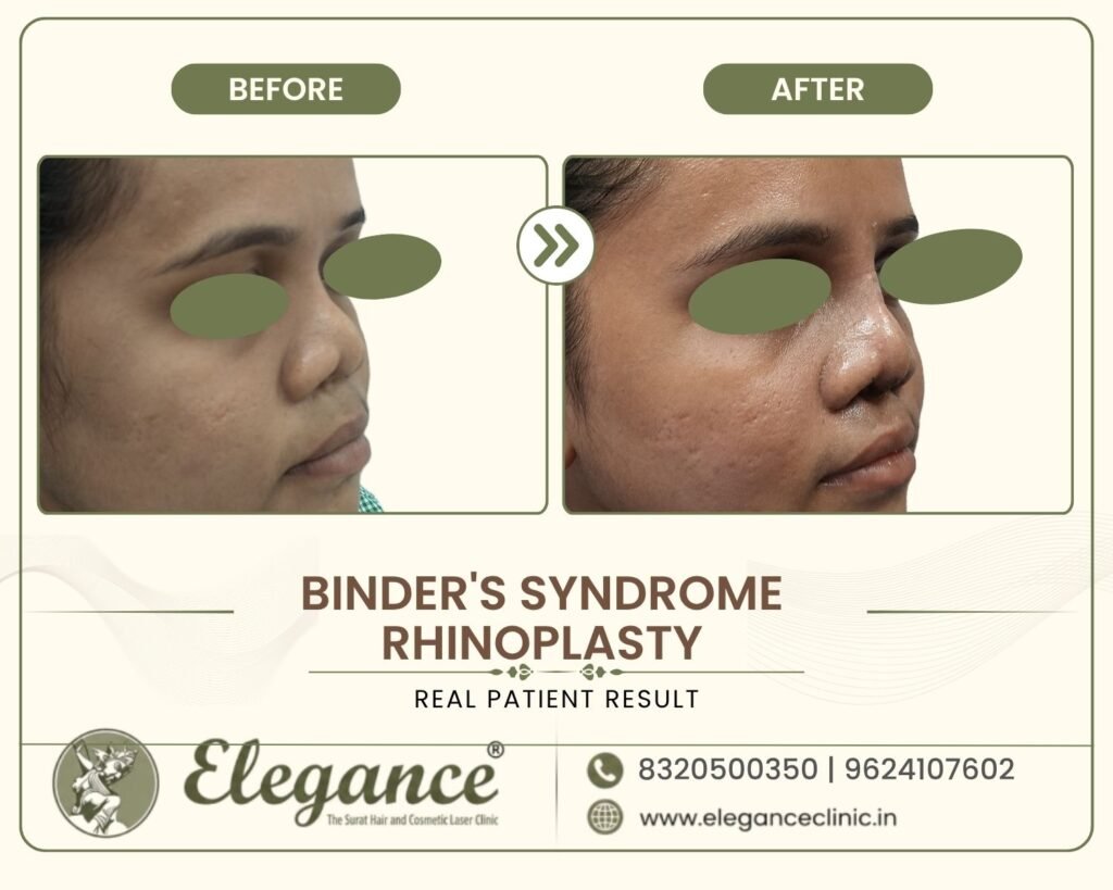 flat-midface-nose-correction-binders-surat