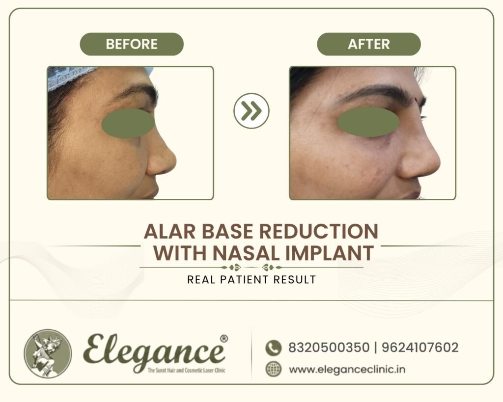 flat-nose-correction-implant-alar-reduction-surat