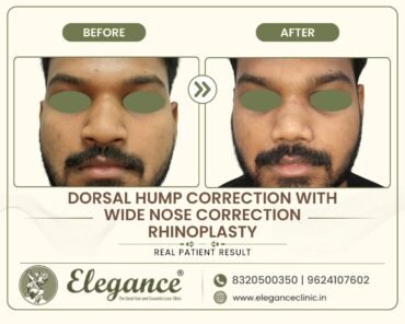 hump-and-broad-nose-correction-male-front-view-surat
