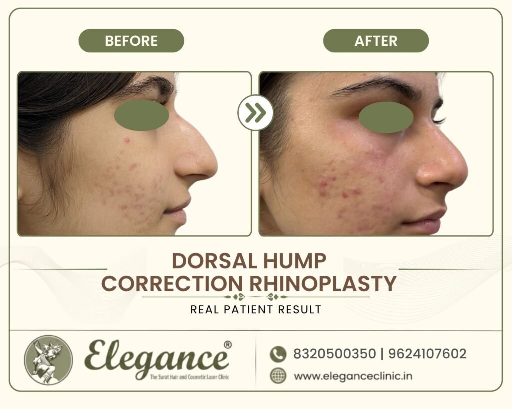 hump-nose-surgery-profile-view-female-surat