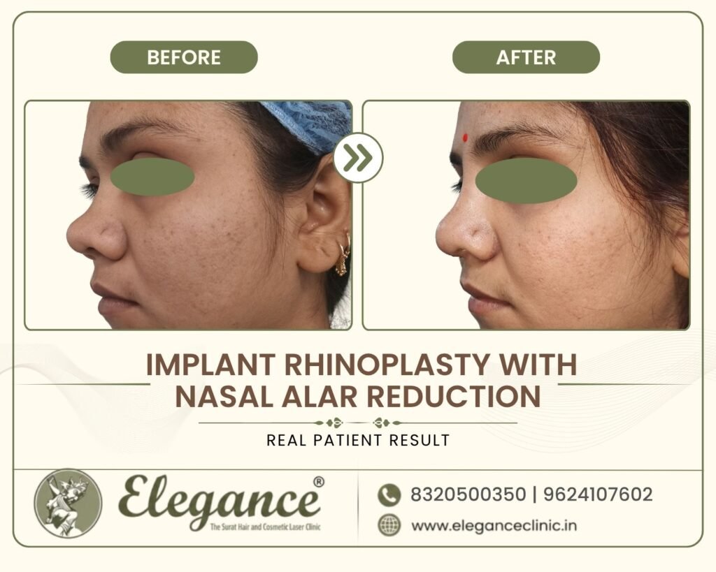 implant-rhinoplasty-alar-reduction-side-profile-surat