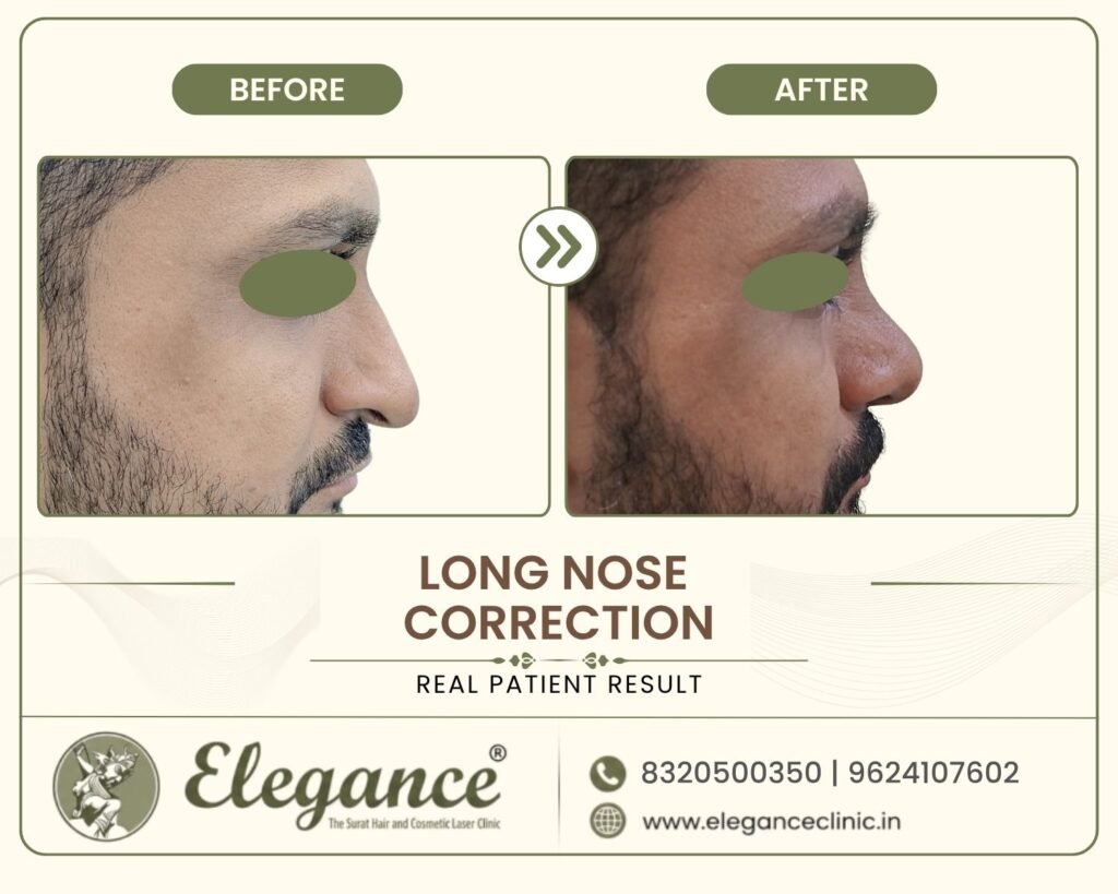 long-drooping-nose-shortening-male-profile-surat