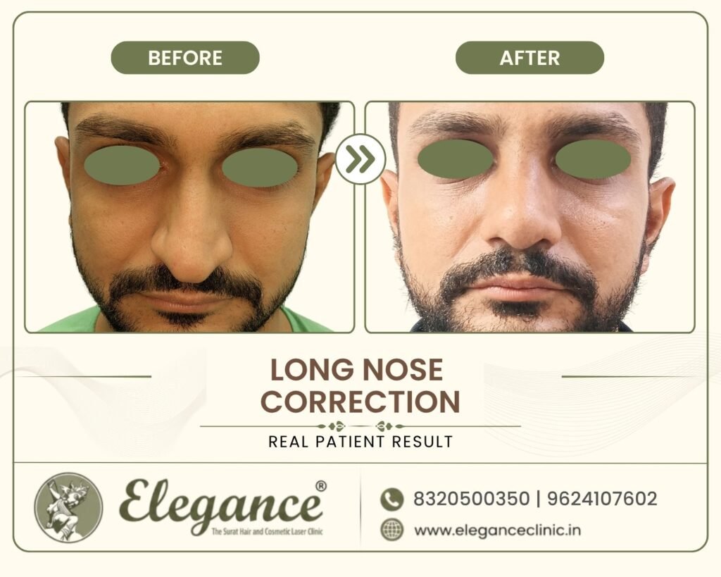 long-nose-correction-rhinoplasty-front-view-surat