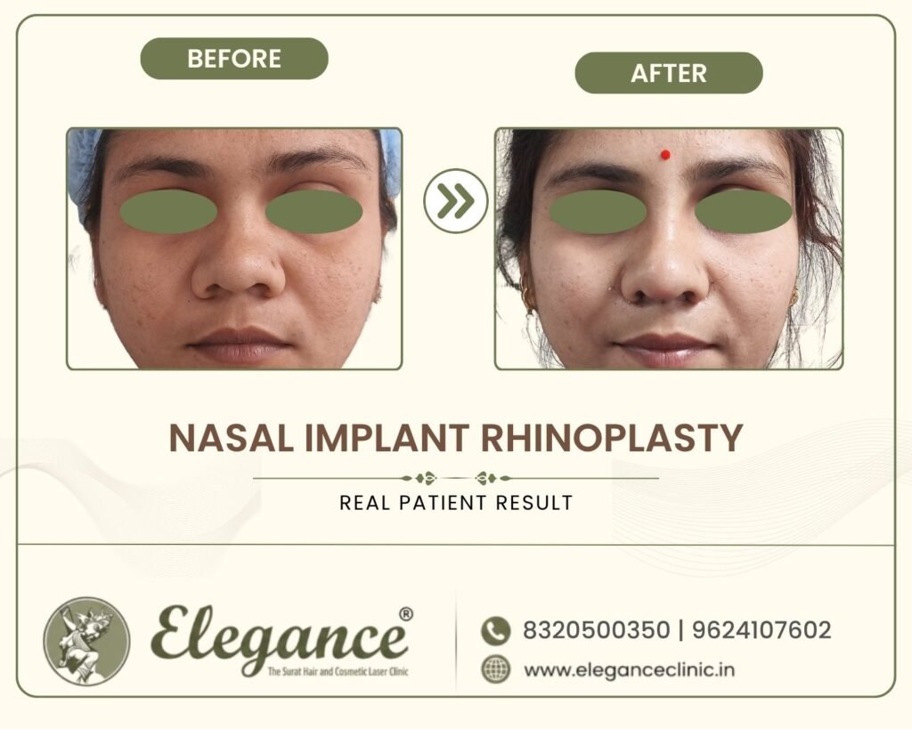 nasal-implant-rhinoplasty-female-front-view-surat