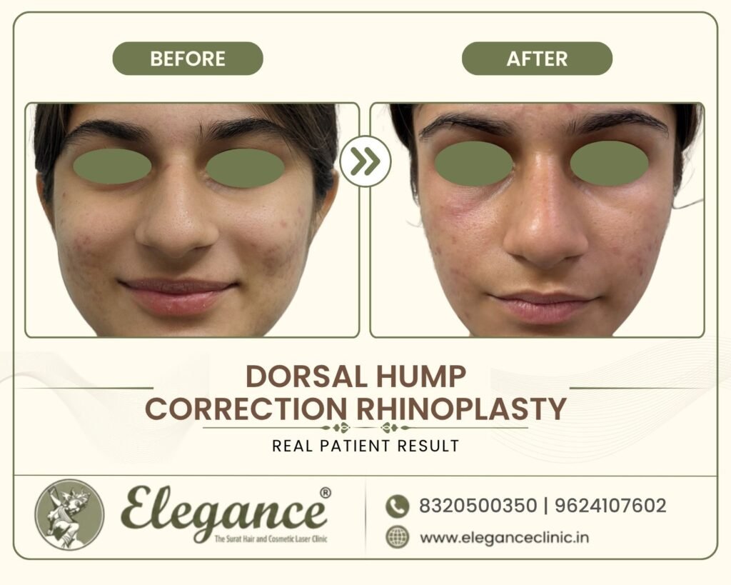 nose-hump-correction-female-front-view-surat