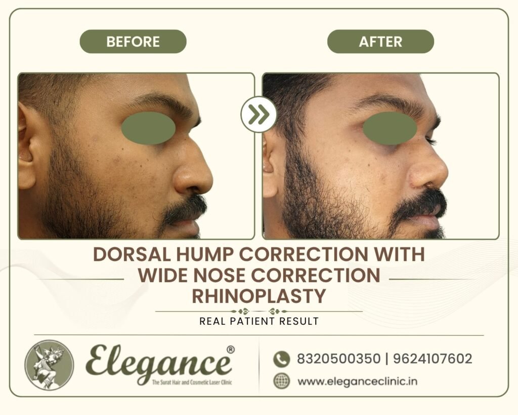 nose-hump-width-reduction-surgery-profile-surat