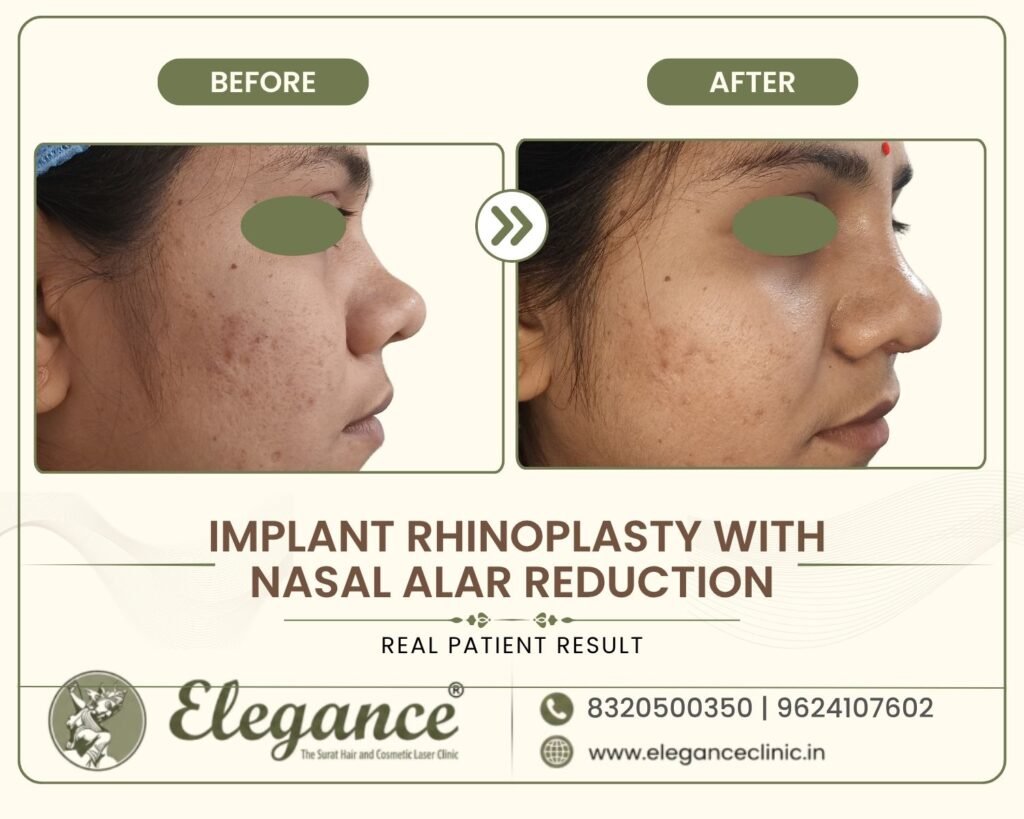 nose-implant-with-nostril-narrowing-angle-view-surat