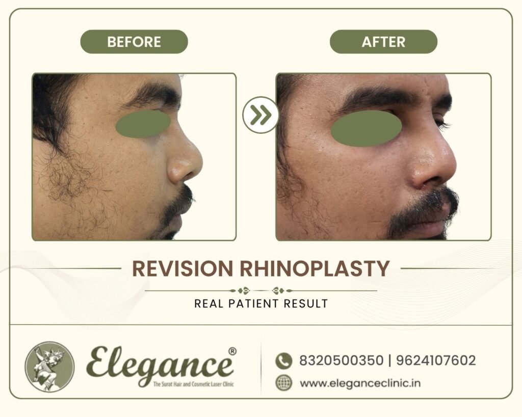 redo-rhinoplasty-correction-angle-view-surat