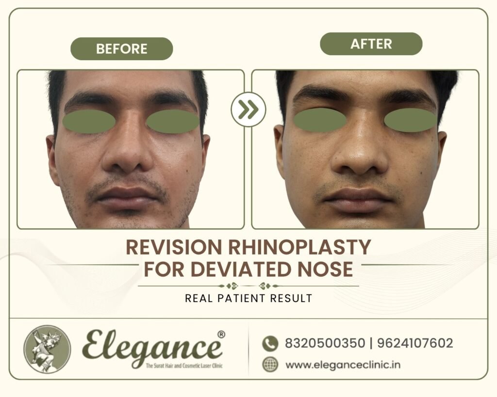 revision-rhinoplasty-deviated-nose-front-view-surat