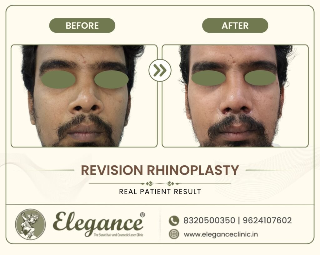 revision-rhinoplasty-male-front-view-surat