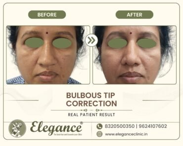 round-nose-tip-refinement-front-view-surat