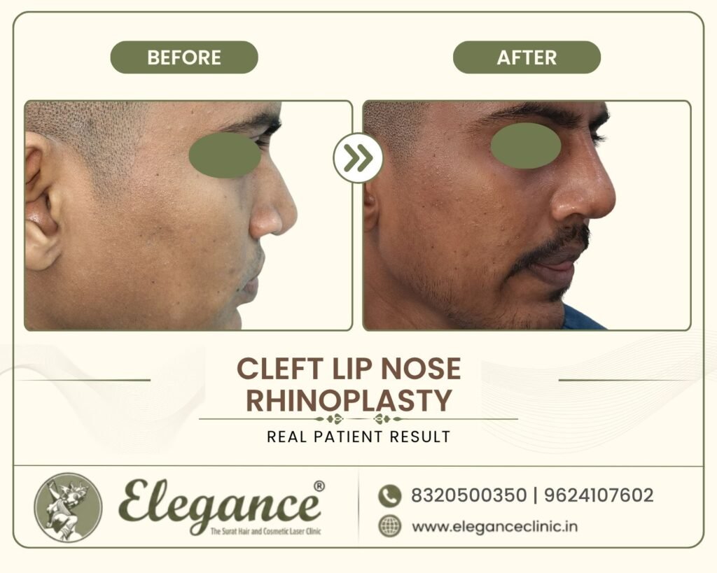 secondary-cleft-rhinoplasty-angle-view-surat