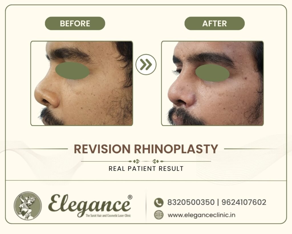 secondary-nose-job-revision-side-profile-suratsecondary-nose-job-revision-side-profile-surat