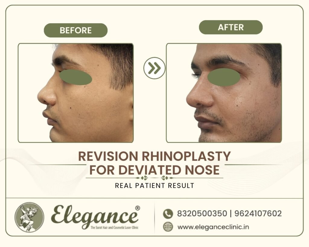 secondary-rhinoplasty-crooked-nose-side-profile-surat