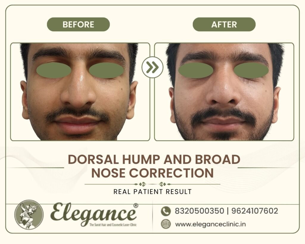 wide-nose-hump-reduction-male-front-view-surat