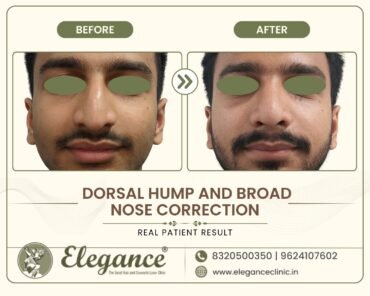 wide-nose-hump-reduction-male-front-view-surat