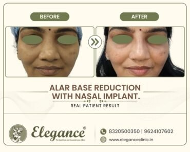 wide-nostril-reduction-with-nose-implant-front-view-surat