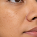 Alar Base Reduction Scar: Where It Sits, How Visible It Gets, And Who Should Not Have Nostril Narrowing