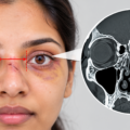 Wide-Set Eyes After A Face Injury: Recognising A Nasoethmoid Fracture Before It Sets
